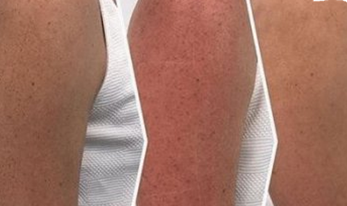 mississauga oakville before after hyperpigmentation correction
